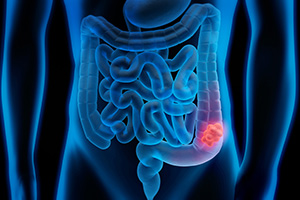 Cancer Colon Cancer Colon