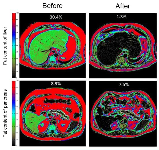 Liver and pancreas, before and after weight loss